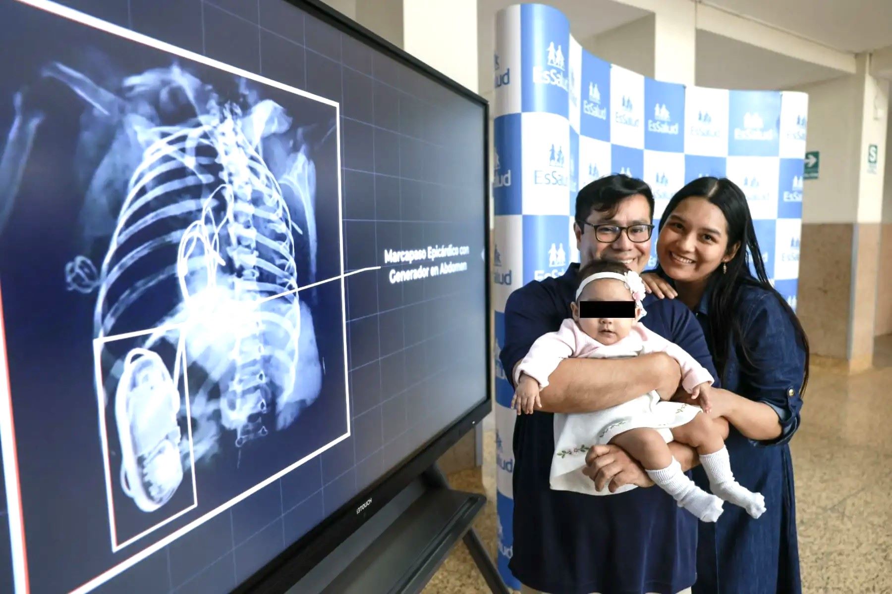 EsSalud realiza primer implante de marcapaso en un bebé prematuro en Latinoamérica